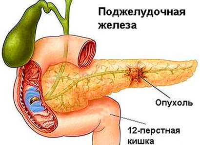 Сладости могут увеличить риск рака поджелудочной железы - отвечает магазин медтехники ME-D.RU